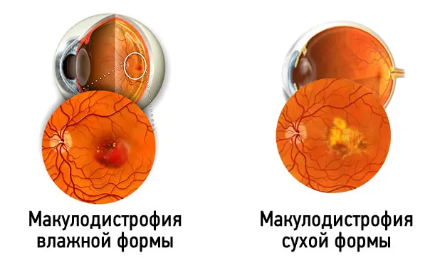 макулодистрофия сухая_влажная