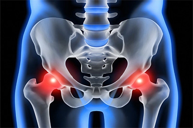 osteoartroz4