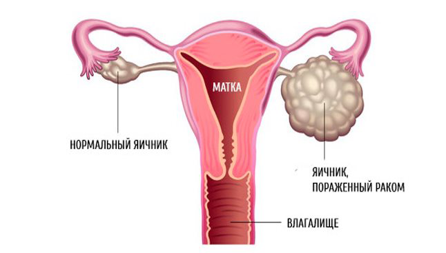 Рак яичников