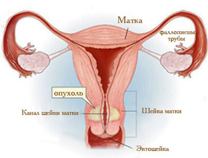 рак шейки матки