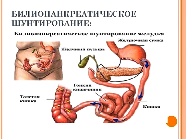 билиопанкреатическое шунтирование