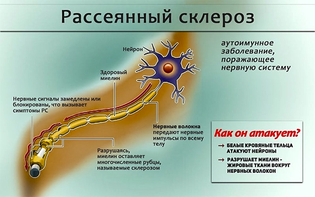 рассеянный склероз