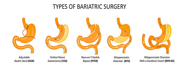 типы бариатрических операций