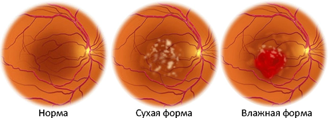 Возрастная макулярная дегенерация