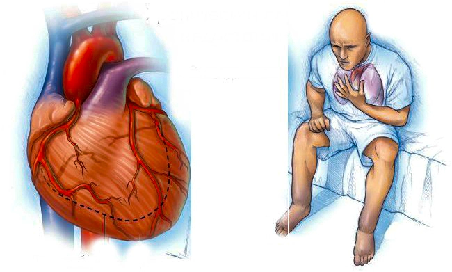 zastoinaja_serdechnaya_nedostatochnost_odishka